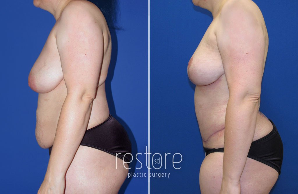 Large Breasts San Diego - Restore SD Plastic Surgery