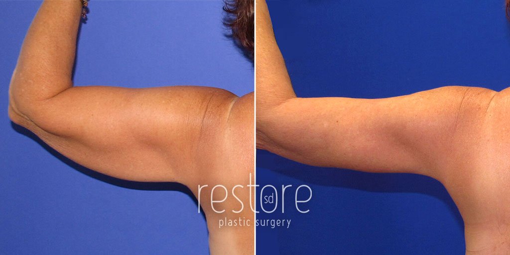 Patient's left upper arm shown before and after arm lift surgery San Diego to remove excess, sagging skin and create a natural contour