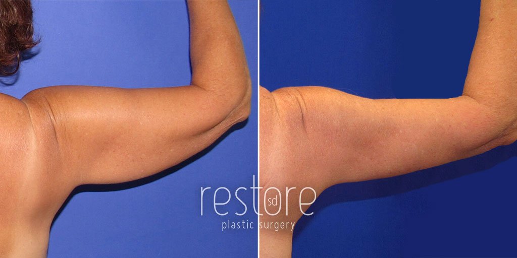 Patient holds right arm up to show excess skin reduction in the upper arm after surgery