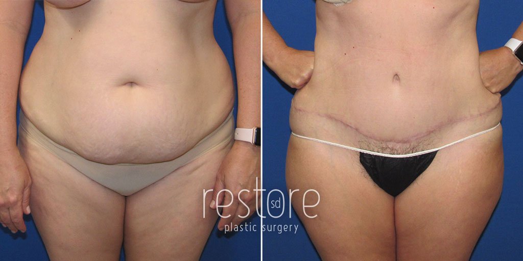tummy-tuck-liposuction-23809a-gallus