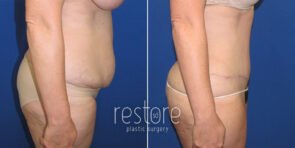 tummy-tuck-liposuction-23809c-gallus