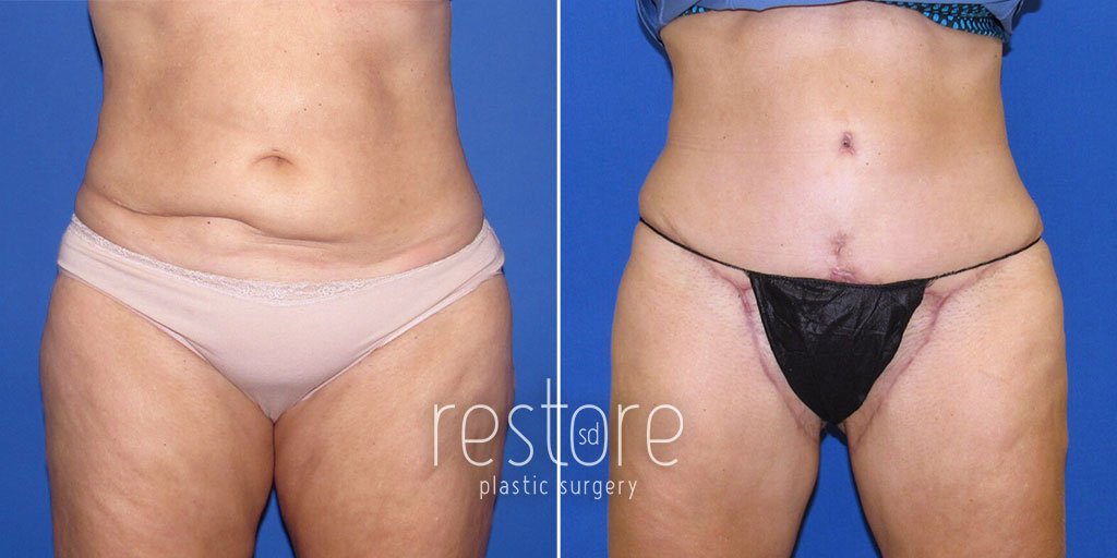 Tummy Tuck and Inner Thigh Lift