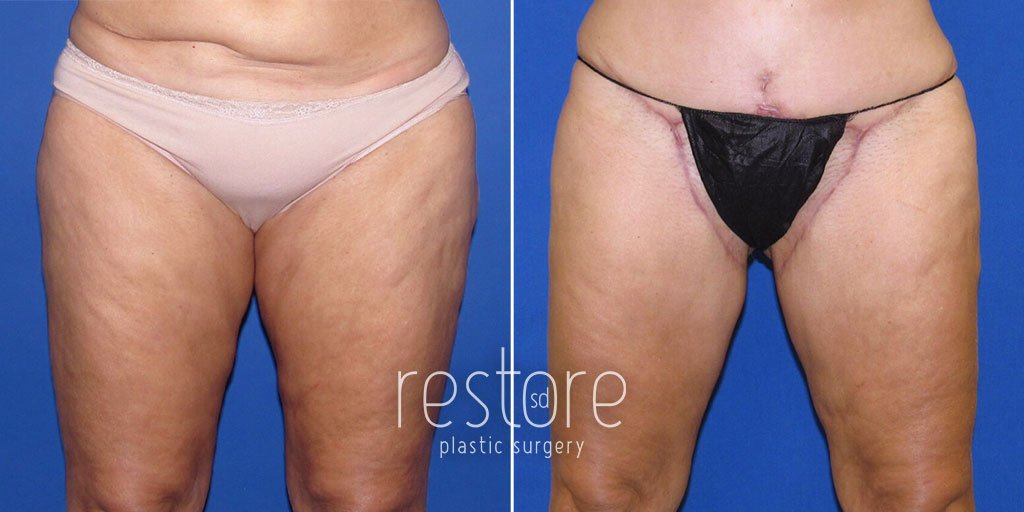 Inner Thigh Lift and Tummy Tuck