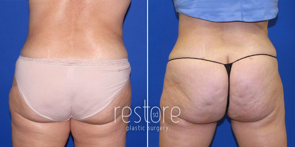 Rear view of patient shown before and after thigh lift surgery to reduce banana rolls beneath the buttocks, remove excess skin, and restore a smoother, firmer thigh contour