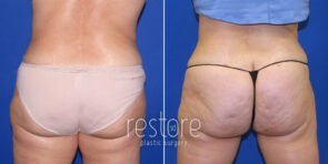 tummy-tuck-thigh-lift-liposuction-24096d-gallus