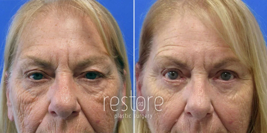 Before and after San Diego eyelid surgery