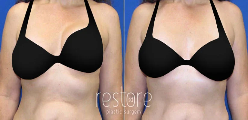 San Diego patient shown before and after breast implant revision surgery to treat capsular contracture.