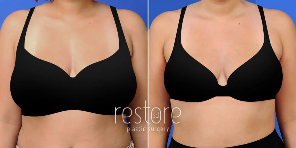 Breast Reduction - Insurance vs. Cosmetic Surgery - Capizzi MD