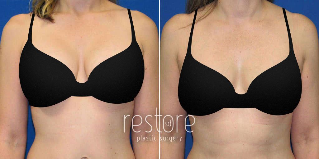 This patient had a previous surgery breast augmentation, then came to Dr. Gallus to have breast implants taken out.