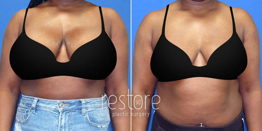A Guide to Natural-Looking Breast Augmentation - Restore SD Plastic Surgery