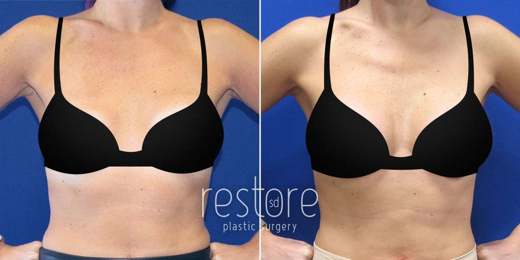 La Jolla plastic surgery patients shown after breast implant revision to replace old 240cc saline breast implants with 325cc silicone implants, in addition to 100cc of fat transfer to each breast for optimal results and a natural appearance.