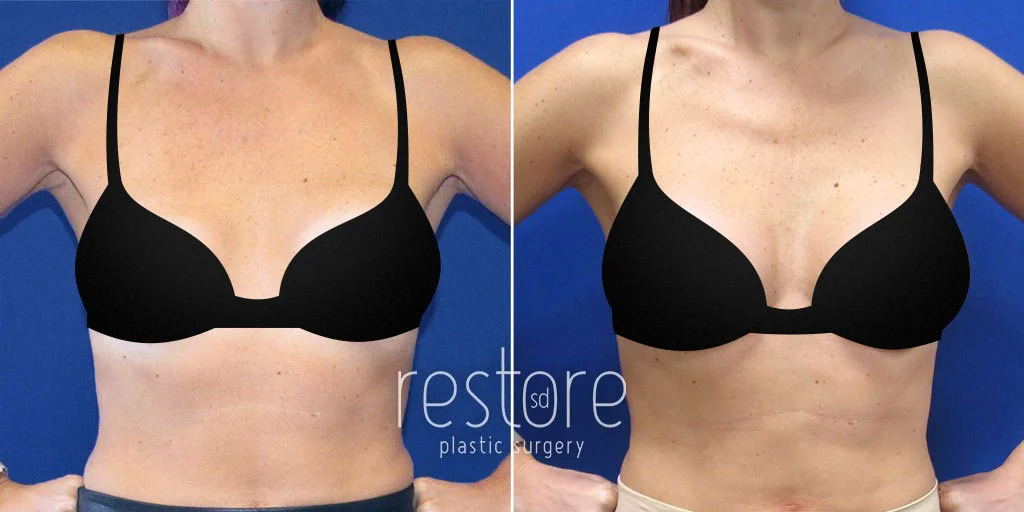 Breast Implant Revision San Diego - Dr. Katerina Gallus offers