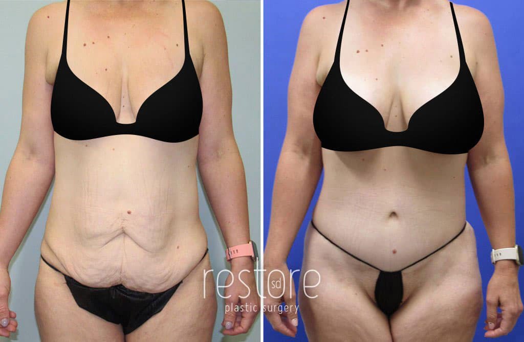 This mothers body was transformed with a combination of procedures: breast lift, breast implants, liposuction, and tummy tuck. In the 