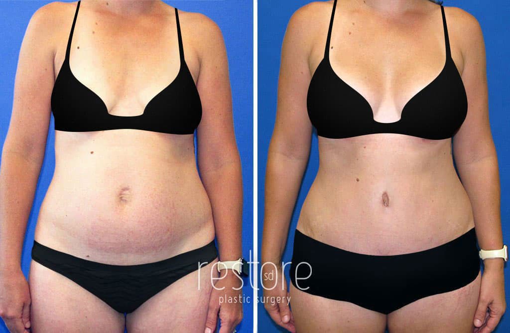 This paient's cosmetic surgery involved breast surgery and abdominal body contouring to restore her pre-baby figure. Our gallery shows mommy makeover scars and the full transformation.