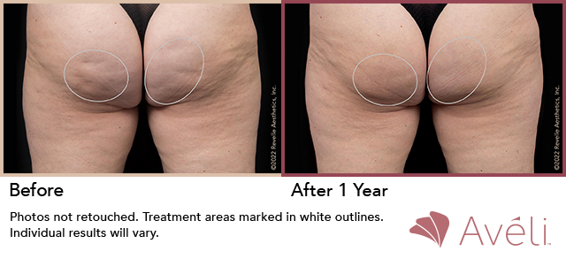 Photo of patient before and after cellulite treatments. Restore SD also offers tattoo removal, laser hair reduction for permanent hair removal, facial procedures, scarless skin tightening procedures, and more! Our office staff would be happy to assist you. 