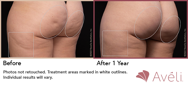Photo of patient before and after cellulite treatments. 