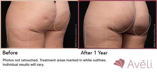 Aveli: First of it's Kind Cellulite Reduction