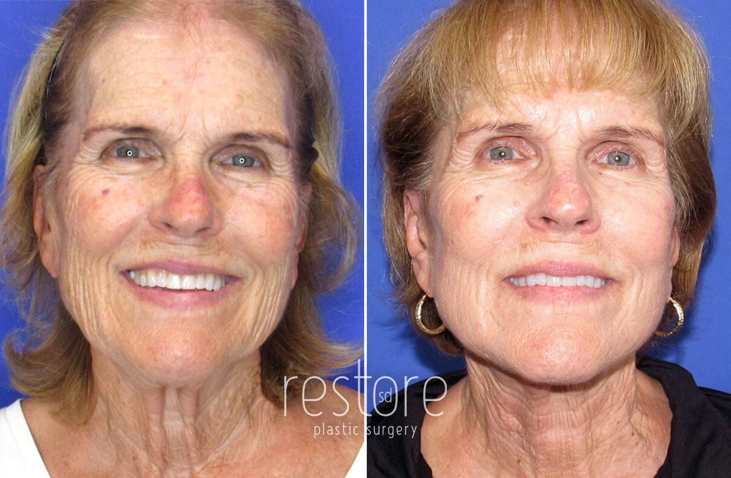 Lower Facelift and Neck Lift