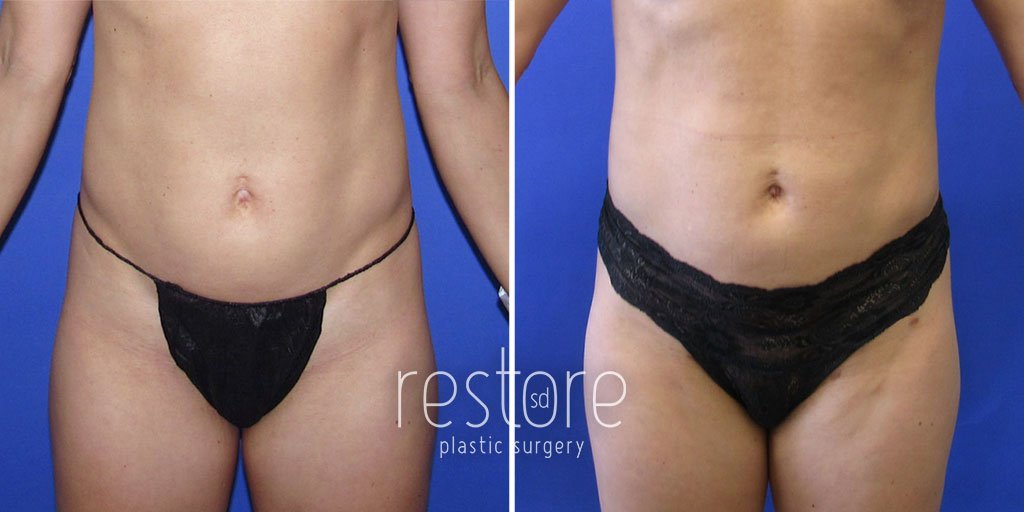 Liposuction with Renuvion
