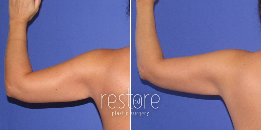 Liposuction Upper Back and Arms