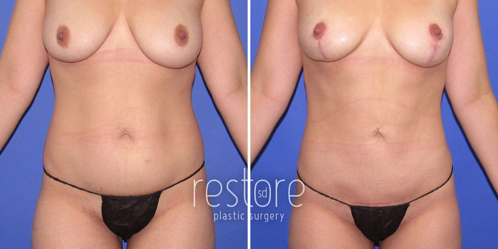 Liposuction with Renuvion