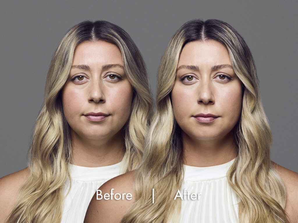 Before and after treatment with RHA fillers