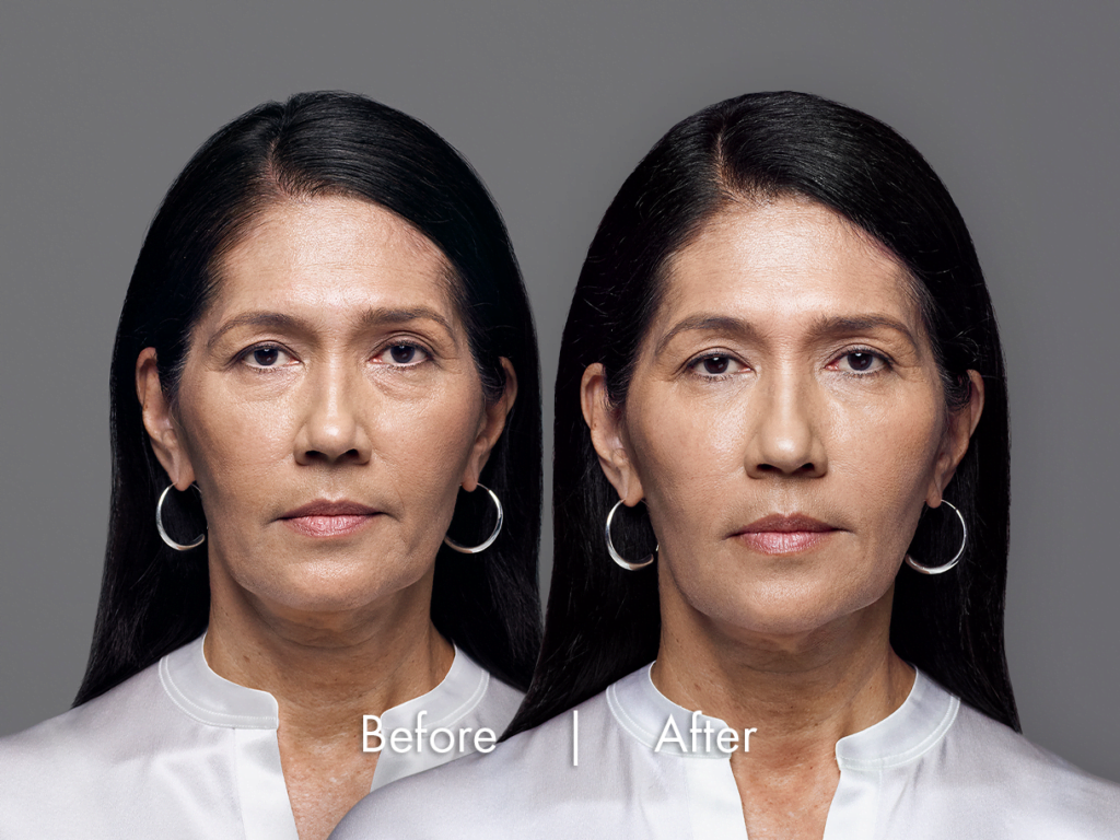 RHA Fillers Before treatment & After Results