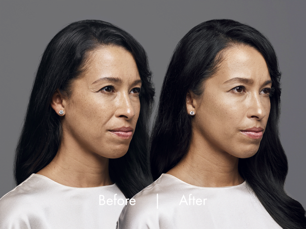 RHA Fillers Before & After Results