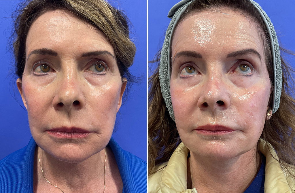 Lower Facelift and Neck Lift