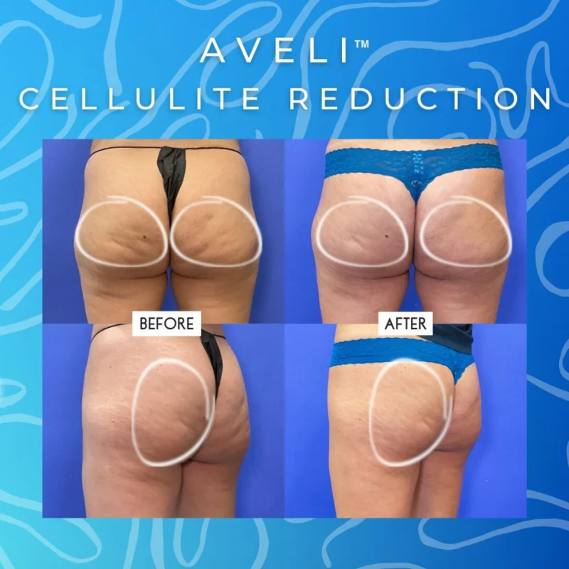 Reduce Cellulite And Improve Skin