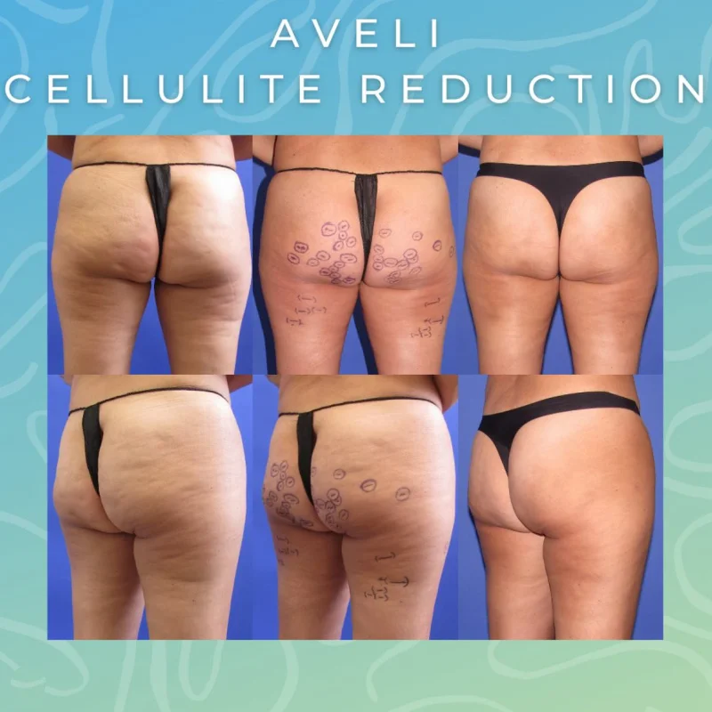 Reduce Cellulite And Improve Skin