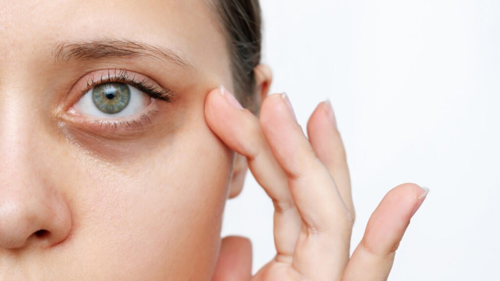 Woman with dark circles under sunken eyes