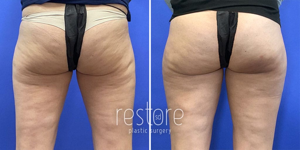 Aveli Cellulite Reduction