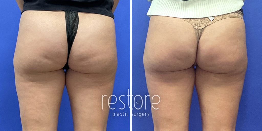 Aveli Cellulite Reduction