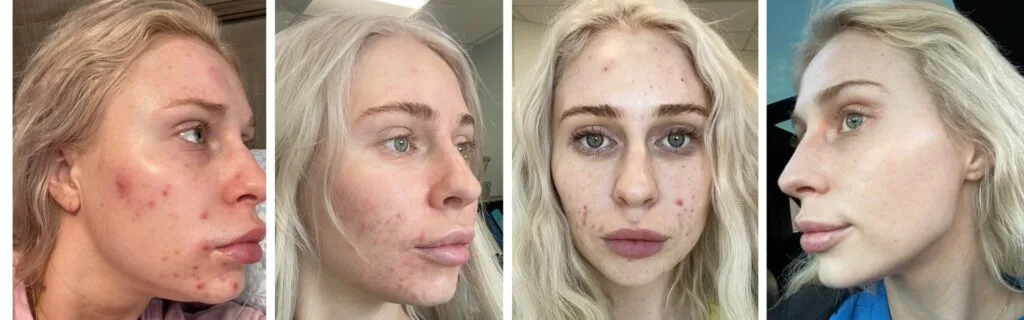 Before and after cystic acne treatment