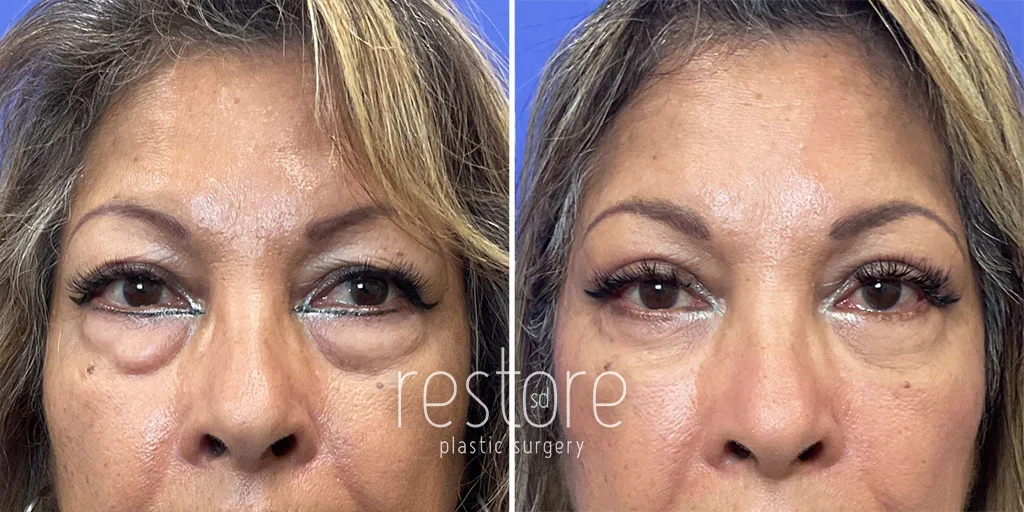 Before and after San Diego eyelid lift