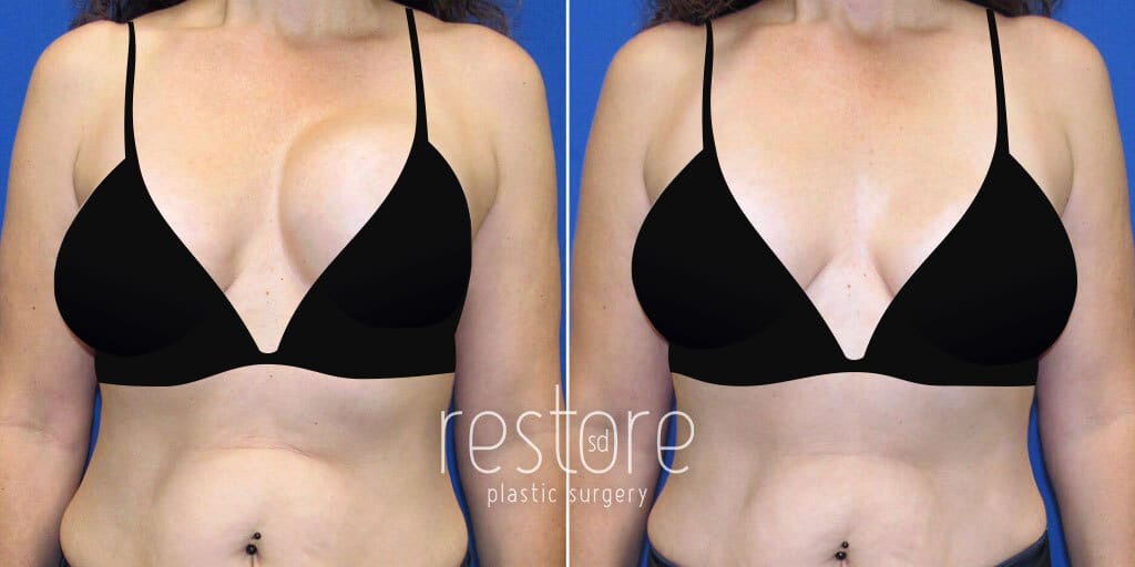 Breast Implant Revision before & after photos