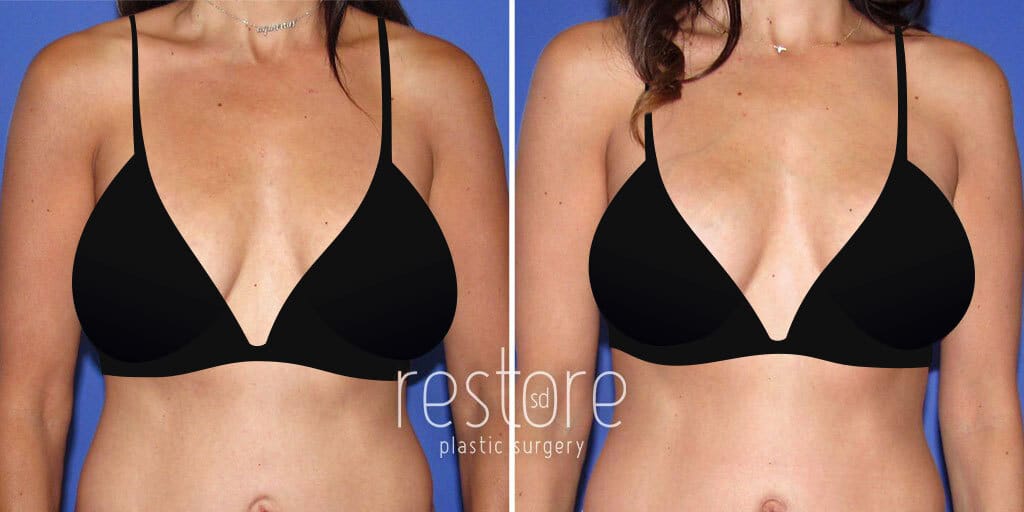 Breast Implant Revision before & after photos