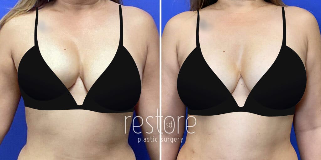 Breast Implant Revision before & after photos