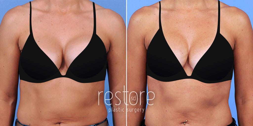 Breast Implant Revision before & after photos
