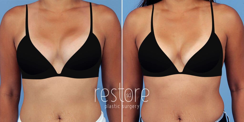 Breast Implant Revision before & after photos