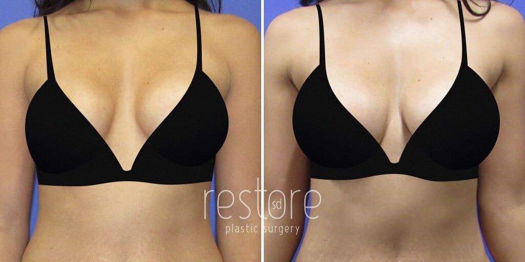 Breast Implant Revision before and after photos