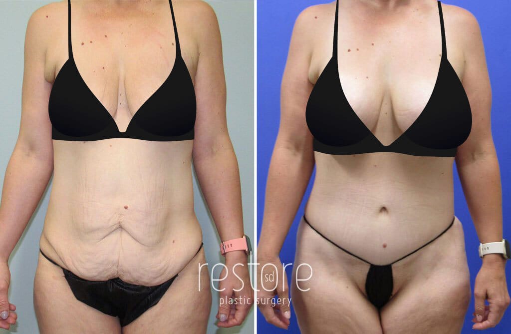 Before and after breast lift with implants and tummy tuck with San Diego mommy makeover surgeon Dr. Kat Gallus