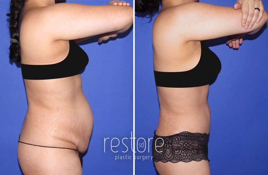 Before and after mommy makeover with Dr. Gallus in San Diego