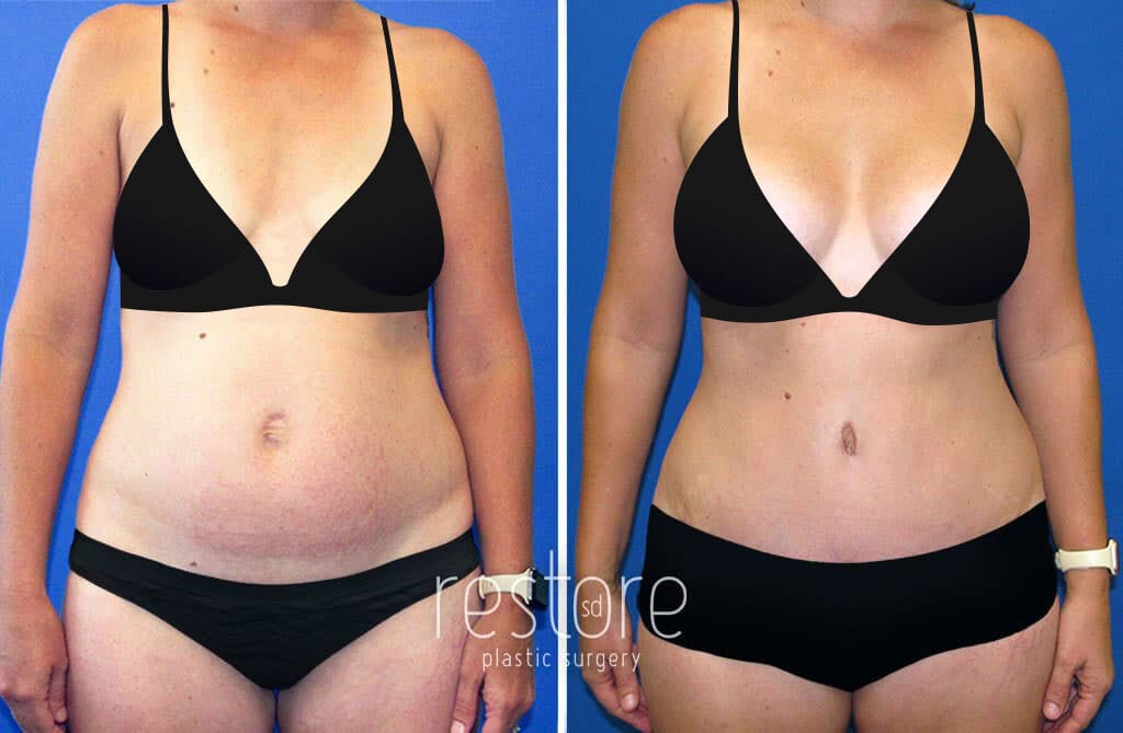 Before and after San Diego mommy makeover with Dr. Kat Gallus