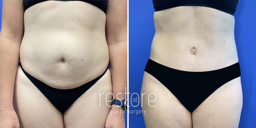 Tummy Tuck with Liposuction
