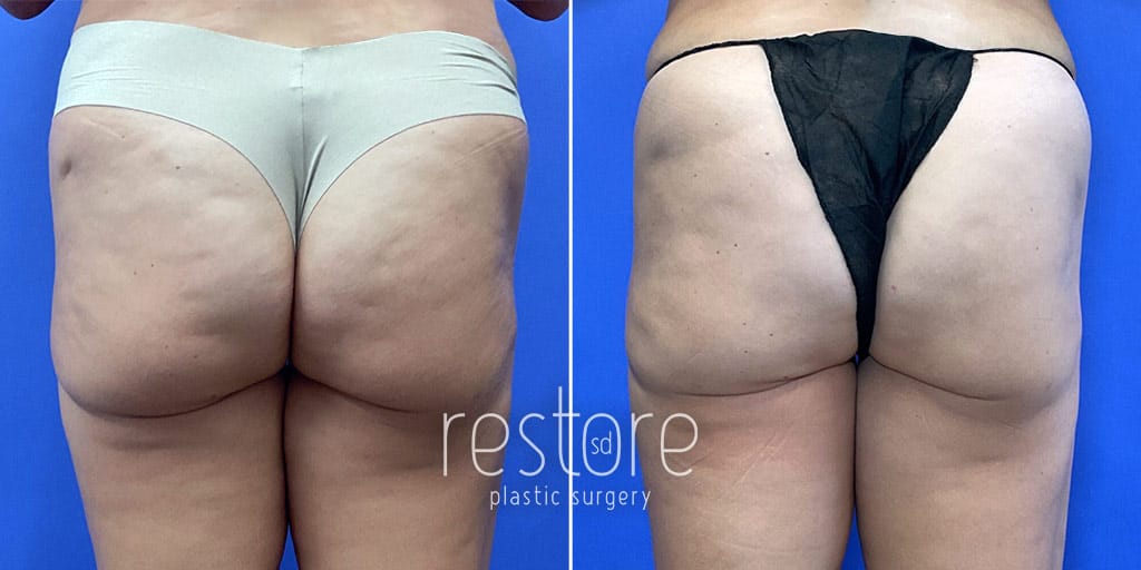Before and after Aveli cellulite treatment with fat grafting in San Diego with Dr. Gallus of Restore SD Plastic Surgery